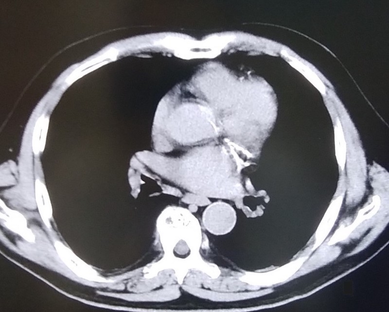 胸膜プラーク（胸膜肥厚斑）