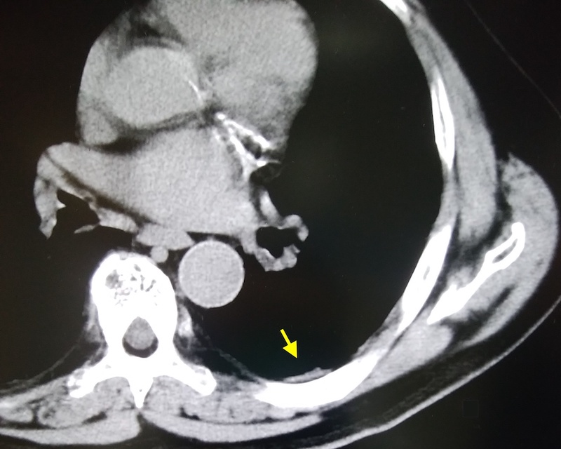 胸膜プラーク（胸膜肥厚斑）